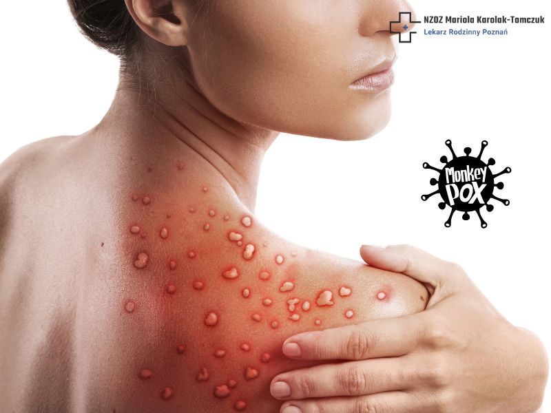 What is Monkeypox?