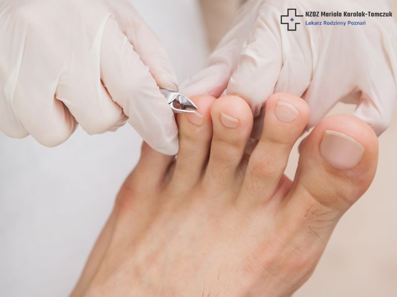 How to cut toenails: how to trim them so they don't become ingrown?