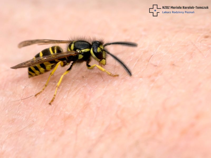 Wasp, hornet, or blackfly bite: regular swelling or an allergic reaction? A patient's guide for the peak season